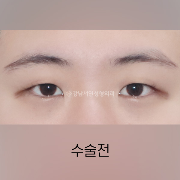 절개쌍꺼풀 + 앞트임 BEFORE