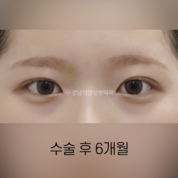 인라인 쌍꺼풀 AFTER