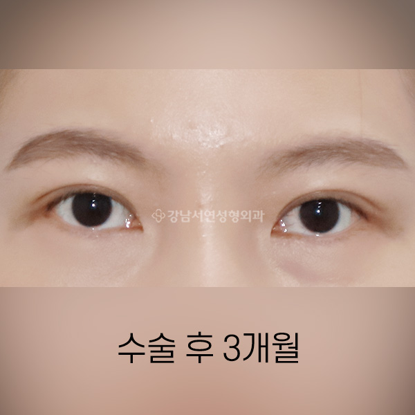 쌍꺼풀 재수술 AFTER