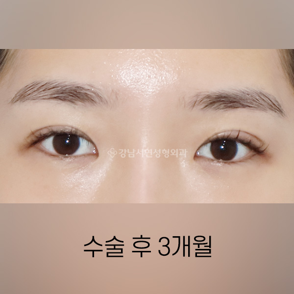 두줄따기 + 눈매교정 AFTER