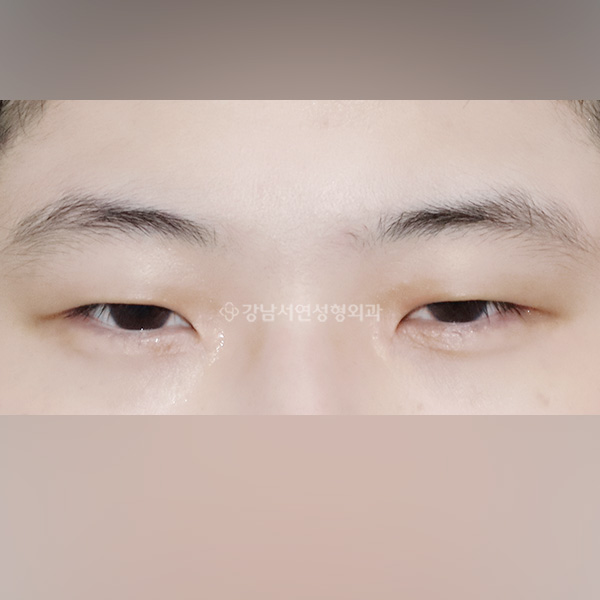 남자무쌍눈매교정 BEFORE