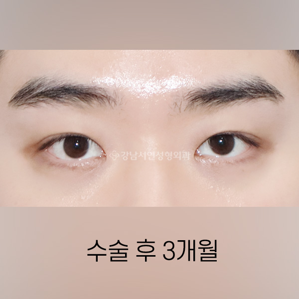 남자 라인낮추기 AFTER