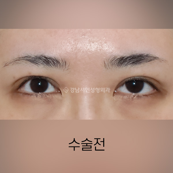 안검 퇴축수술 BEFORE
