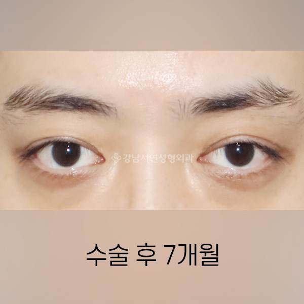 라인낮추기 AFTER