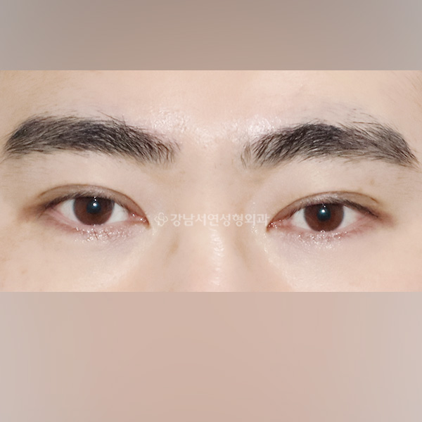 남자 쌍꺼풀 낮추기 BEFORE