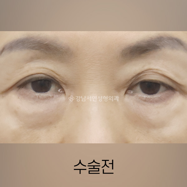 절개쌍꺼풀 + 하안검 재수술 BEFORE