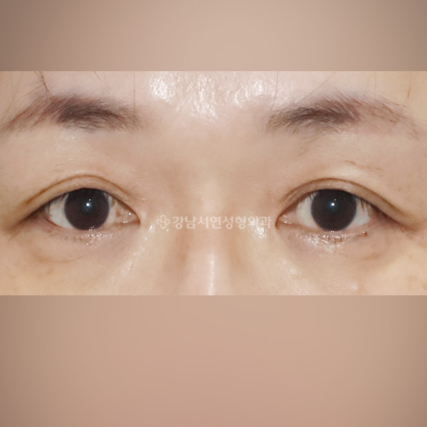 상안검 처짐개선 BEFORE