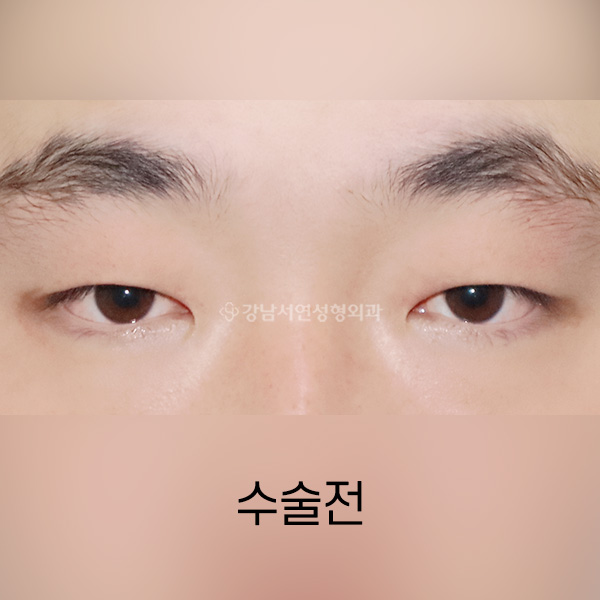 남자 무쌍(속쌍)수술  BEFORE