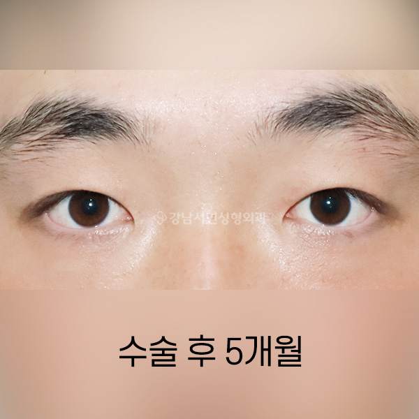 남자 무쌍(속쌍)수술  AFTER