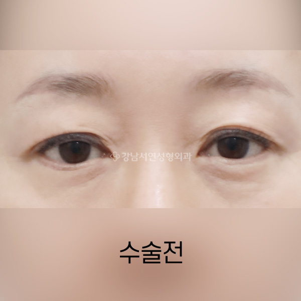 상안검 BEFORE