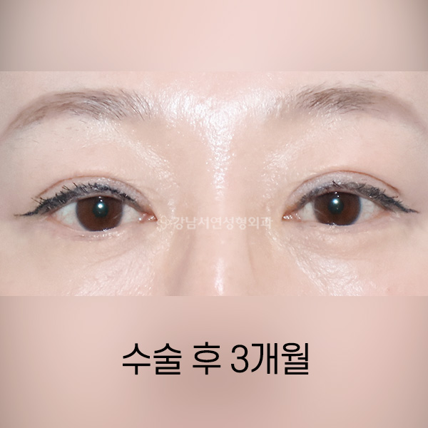 상안검 AFTER