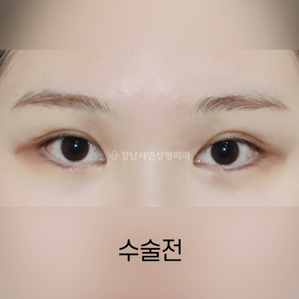 두줄따기 BEFORE