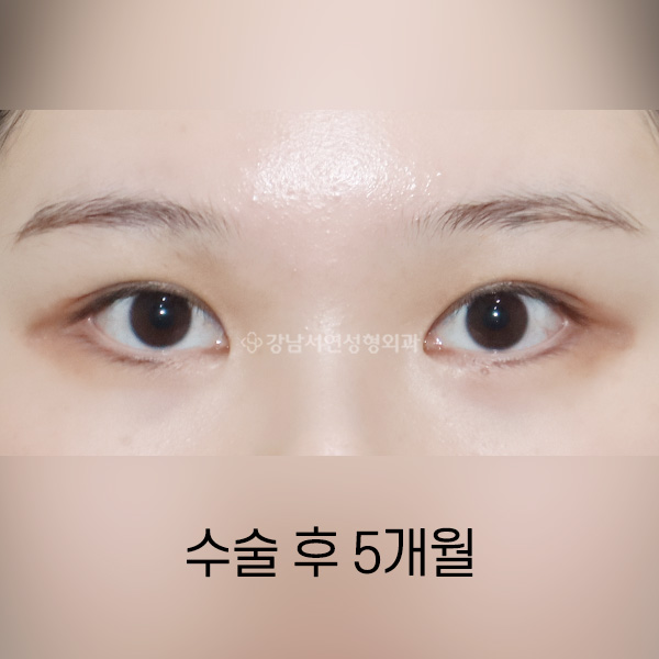 두줄따기 AFTER
