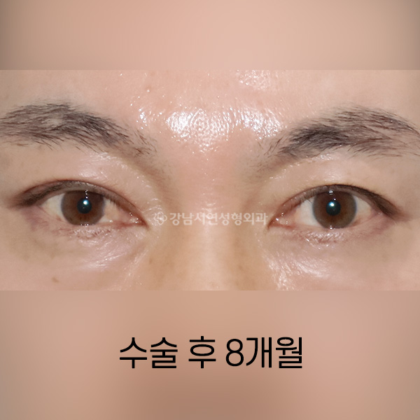 남자쌍꺼풀 낮추기 AFTER