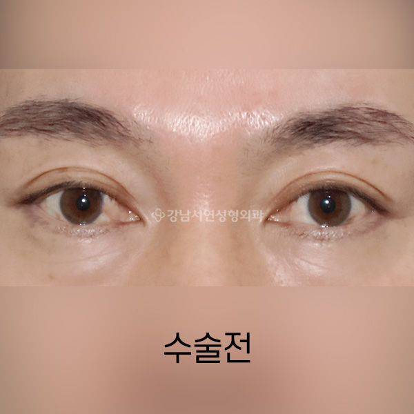 남자쌍꺼풀 낮추기 BEFORE