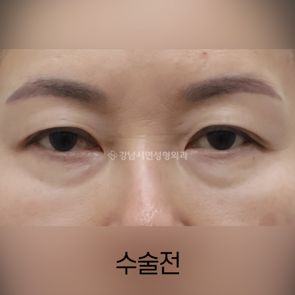 눈밑지방재배치 BEFORE