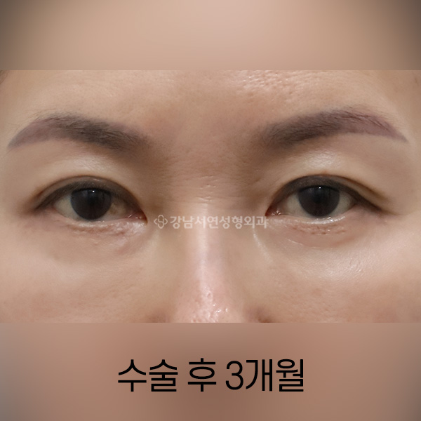 눈밑지방재배치 AFTER