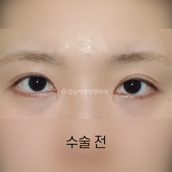안검 퇴축 수술 + 비대칭 교정 BEFORE