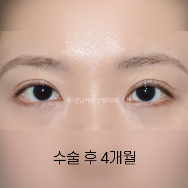 안검 퇴축 수술 + 비대칭 교정 AFTER