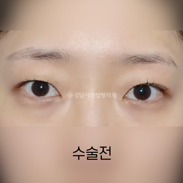 매몰쌍꺼풀 BEFORE