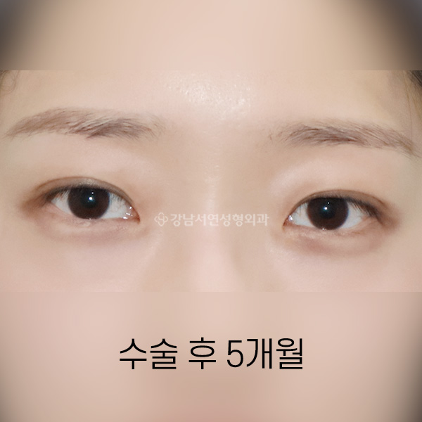 매몰쌍꺼풀 AFTER