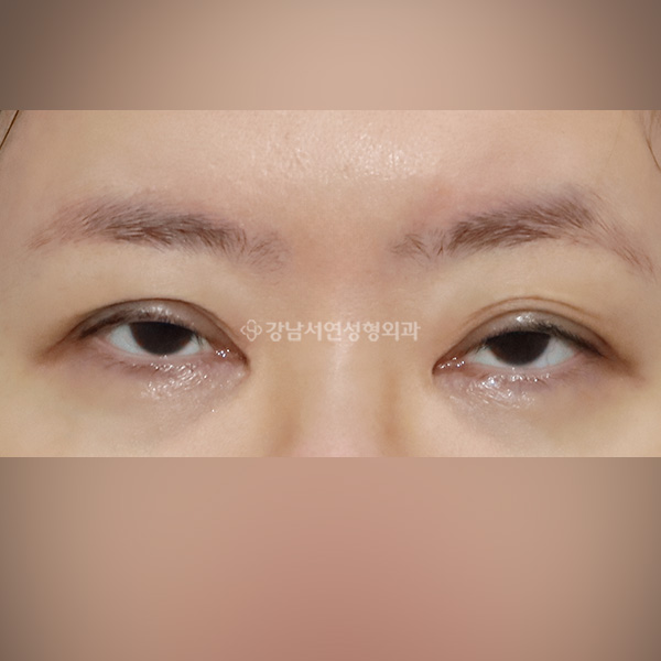 극한 졸린눈 재수술 BEFORE