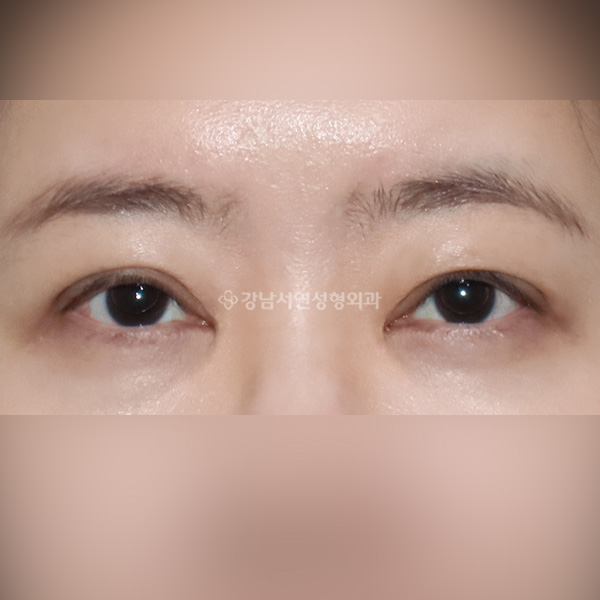 극한 졸린눈 재수술 AFTER