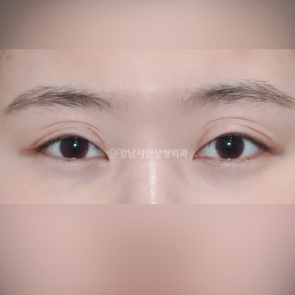 여러겹 극한 겹주름 BEFORE