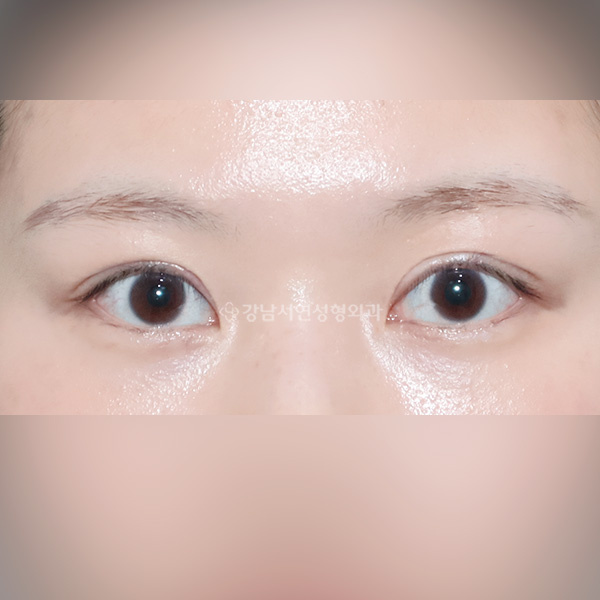 여러겹 극한 겹주름 AFTER