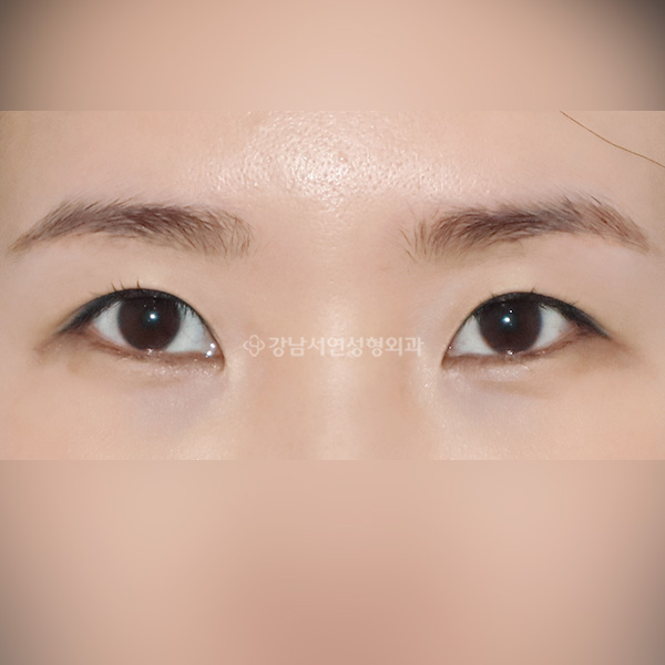 라인높이기 BEFORE