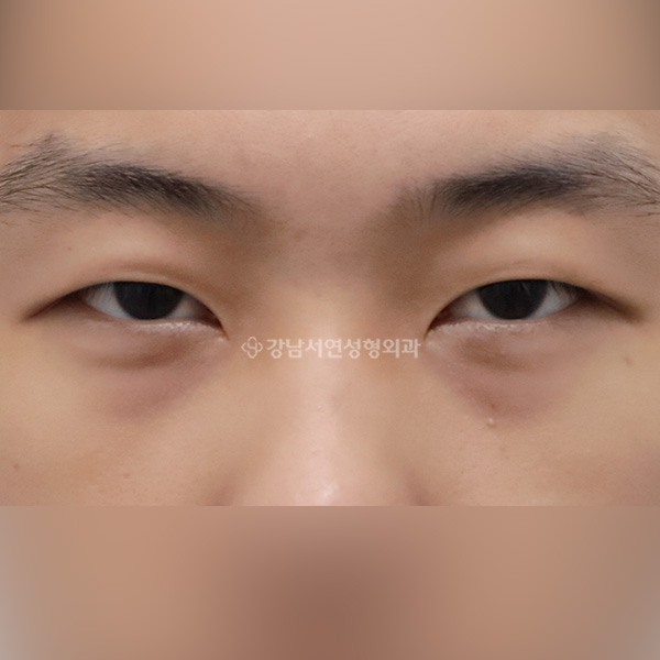 눈밑지방재배치 BEFORE