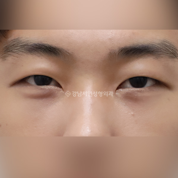 눈밑지방재배치 AFTER