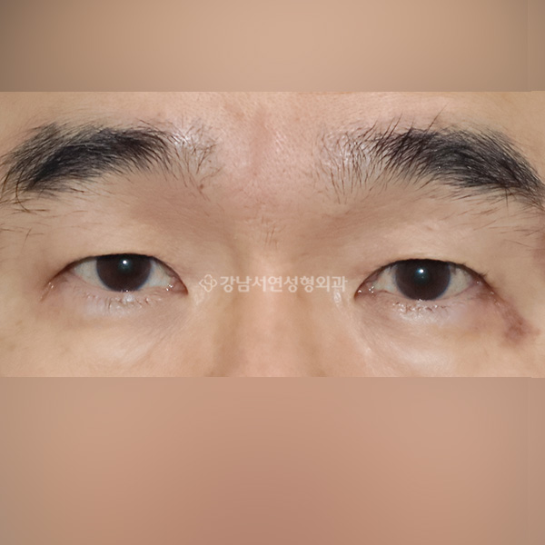 남자 중년 상안검 BEFORE