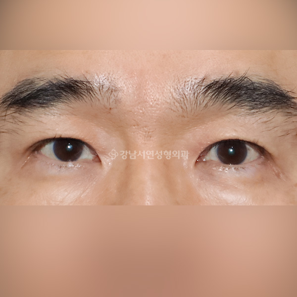 남자 중년 상안검 AFTER