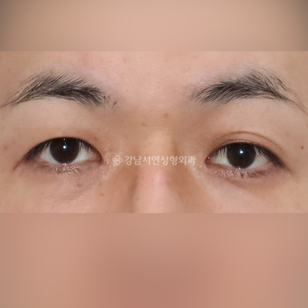 남자 쌍꺼풀 낮추기 BEFORE