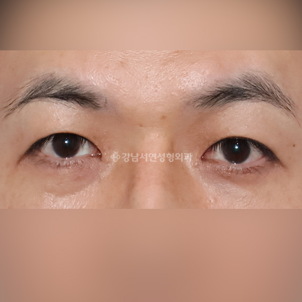 남자 쌍꺼풀 낮추기 AFTER