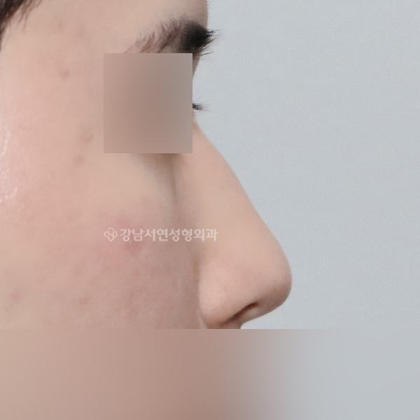 무보형물 코성형 BEFORE