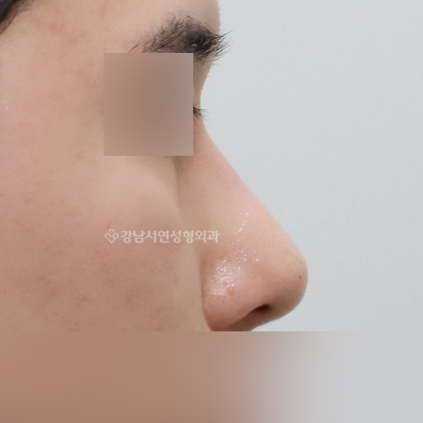 무보형물 코성형 AFTER